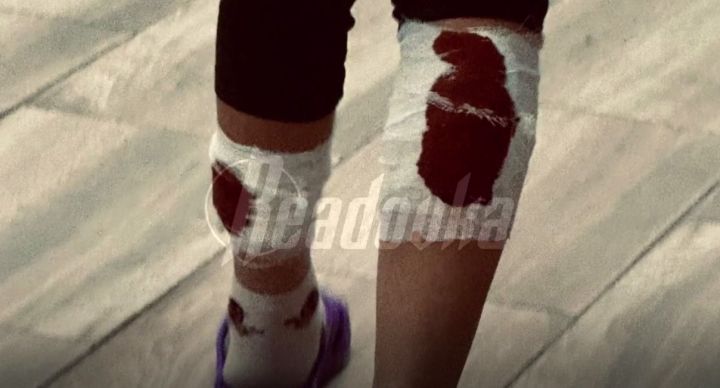 В Ивановской области собаки сильно изодрали ребёнка: скорая дважды отказалась приезжать к пострадавшей