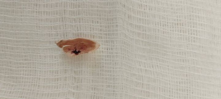 В ЛНР 4-летняя девочка чуть не умерла из-за скорлупы от фисташки