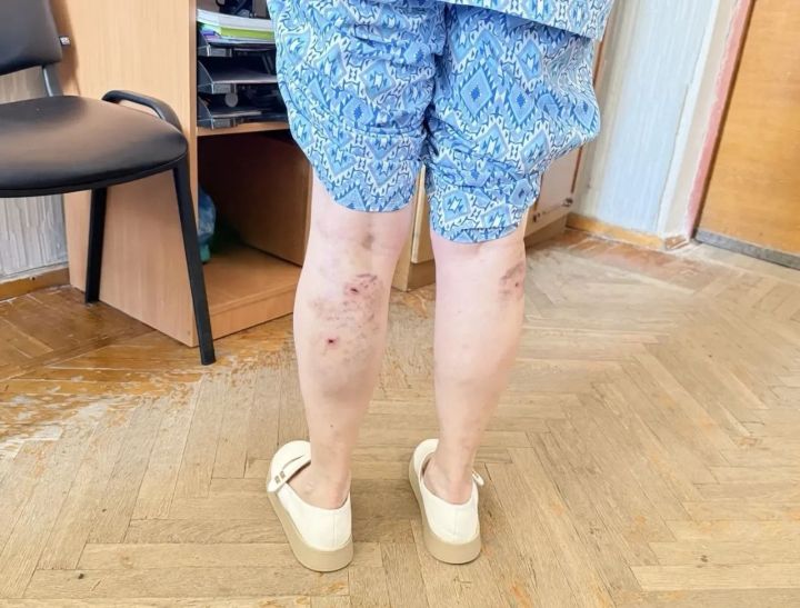 В Рубежном стая бродячих собак покусала женщину